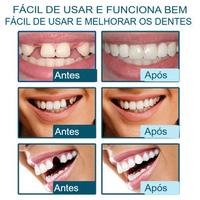Smile Fit - Facetas Dentárias Removíveis